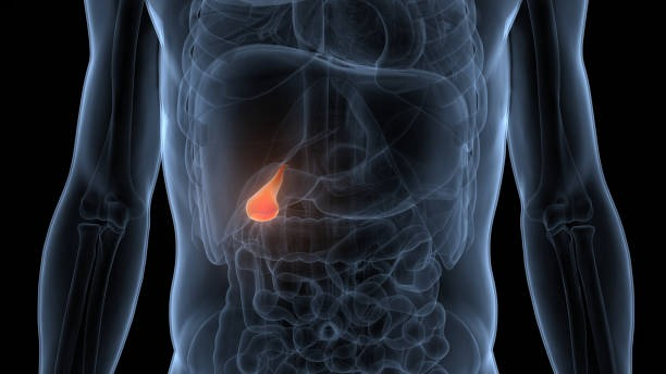 What Size of Gallbladder Stones Need Surgery?